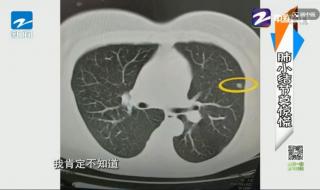 肺部结节能自然消退吗